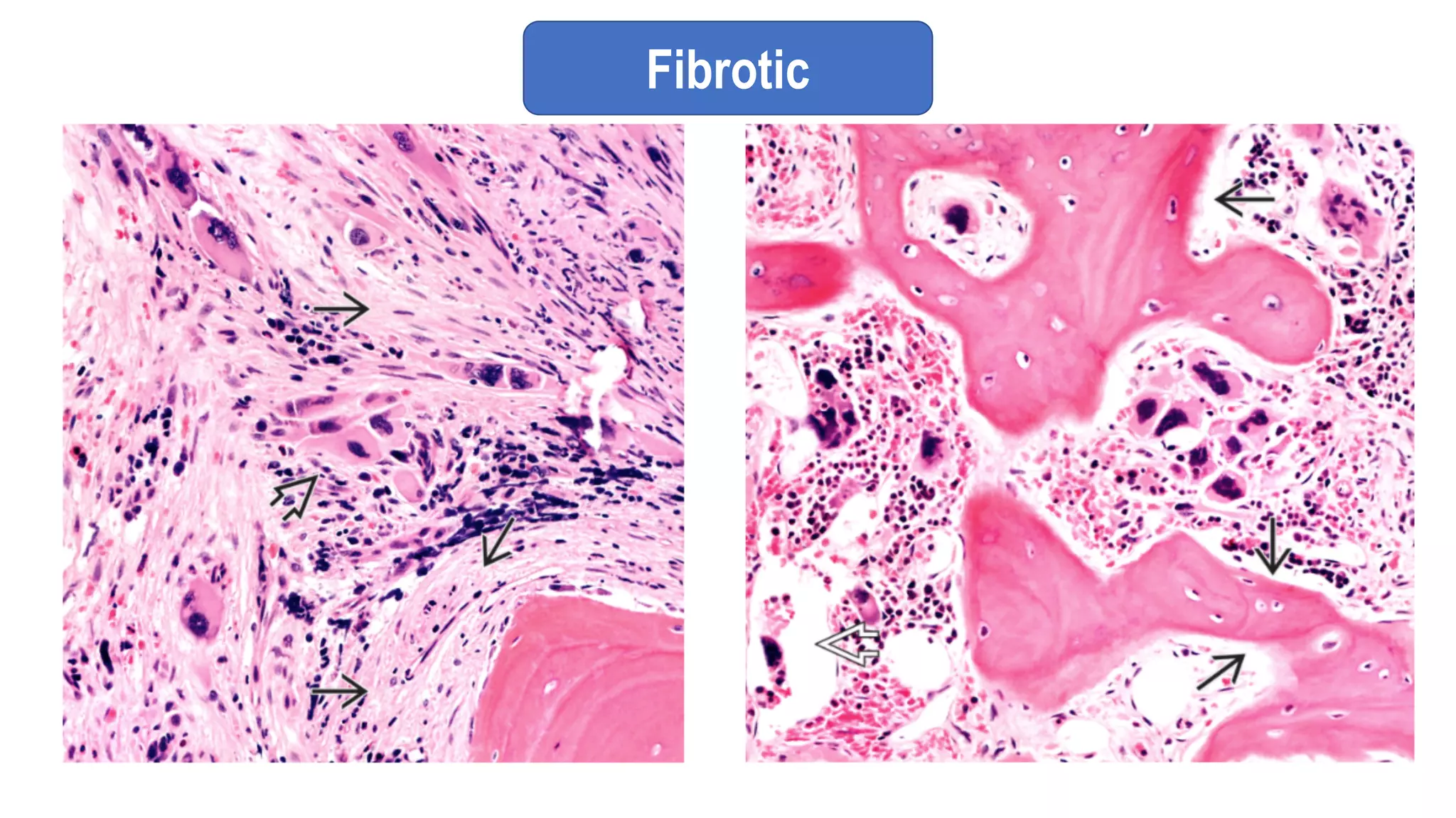 Fibrotic
 