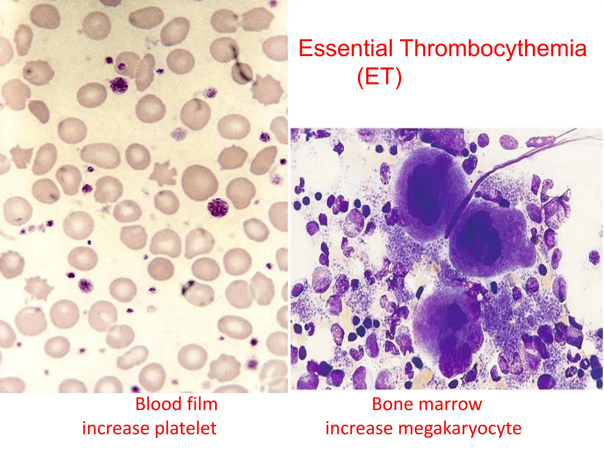 Blood film Bone marrow
increase platelet increase megakaryocyte
Essential Thrombocythemia
(ET)
 