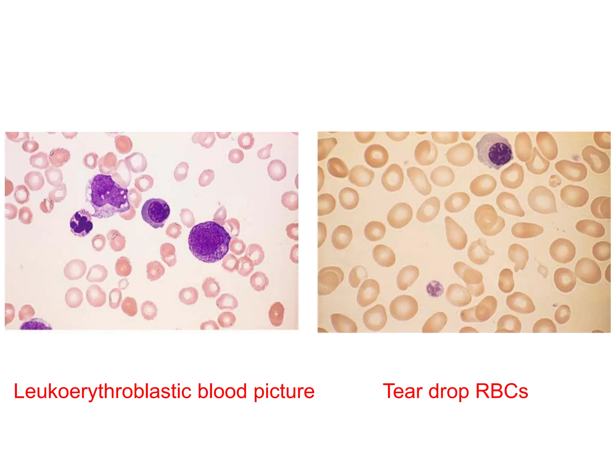 Leukoerythroblastic blood picture Tear drop RBCs
 