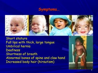 Symptoms…Symptoms…
66
Short stature
Full lips with thick, large tongue
Umbilical hernia
Deafness
Shortness of breath
Abnormal bones of spine and claw hand
Increased body hair (hirsutism)
 