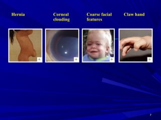 77
Key Symptom Images
Hernia Corneal
clouding
Coarse facial
features
Claw hand
 