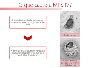 O que causa a MPS IV?
O acúmulo desses GAGs nos lisossomos
leva à perturbação da função normal das
células.
A disfunção celular resulta em morbidades
multissistêmicas progressivas, que são a
característica desta doença.
Células normais
Células no Morquio A
com acúmulo de GAG
nos lisossomos
 