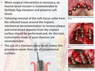 Implant related periodontal disease | PPTX
