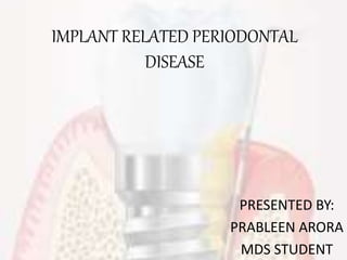 IMPLANT RELATED PERIODONTAL
DISEASE
PRESENTED BY:
PRABLEEN ARORA
MDS STUDENT
 