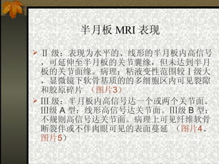 半月板 MRI 表现   Ⅱ 级：表现为水平的、线形的半月板内高信号，可延伸至半月板的关节囊缘，但未达到半月板的关节面缘。病理：粘液变性范围较Ⅰ级大，显微镜下软骨基质的的多细胞区内可见裂隙和胶原碎片   （图片 3 ） Ⅲ 级：半月板内高信号达一个或两个关节面。Ⅲ级 A 型：线形高信号达关节面。Ⅲ级 B 型：不规则高信号达关节面。病理上可见纤维软骨断裂伴或不伴肉眼可见的表面蔓延   （ 图片 4 、 图片 5 ） 
