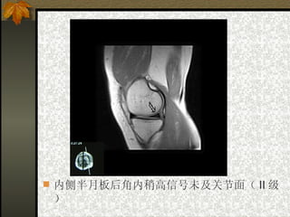 内侧半月板后角内稍高信号未及关节面（ II 级） 