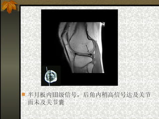 半月板内Ⅲ级信号，后角内稍高信号达及关节面未及关节囊 