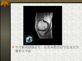半月板内Ⅲ级信号，后角内稍高信号达及关节囊和关节面   