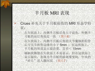 半月板 MRI 表现   Crues 补充关于半月板损伤的 MRI 形态学特征： 在矢状面上，内侧半月板后角大于前角，外侧半月板的前后角接近一致   （ 图片 6 ） 在矢状面上，内侧半月板后角的关节囊缘距胫骨后方关节软骨边缘应小干 5mm  ；在冠状面上，半月板的体部显示最清楚，直径＜ 15mm 桶柄状撕裂在矢状面上不易显示，但在冠状面上显示最佳，表现为半月板的游离缘变钝，中央的“碎片”进入髁间窝   （ 图片 7 ） 