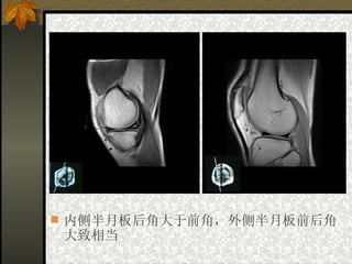 内侧半月板后角大于前角，外侧半月板前后角大致相当 
