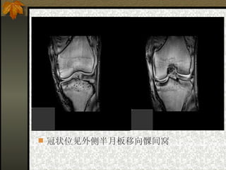 冠状位见外侧半月板移向髁间窝 
