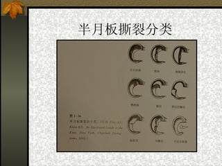 半月板撕裂分类 