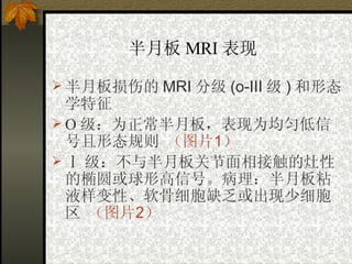 半月板 MRI 表现   半月板损伤的 MRI 分级 (o-III 级 ) 和形态学特征   О 级：为正常半月板，表现为均匀低信号且形态规则   （图片 1 ） Ⅰ 级：不与半月板关节面相接触的灶性的椭圆或球形高信号。病理：半月板粘液样变性、软骨细胞缺乏或出现少细胞区   （图片 2 ） 