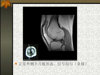 正常外侧半月板形态、信号均匀（ 0 级） 