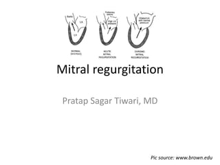 Mitral regurgitation
Pratap Sagar Tiwari, MD
Pic source: www.brown.edu
 