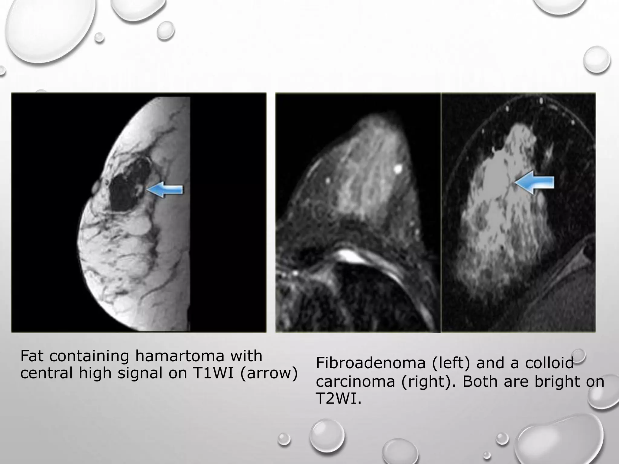 MRI BREAST PPT | PPTX