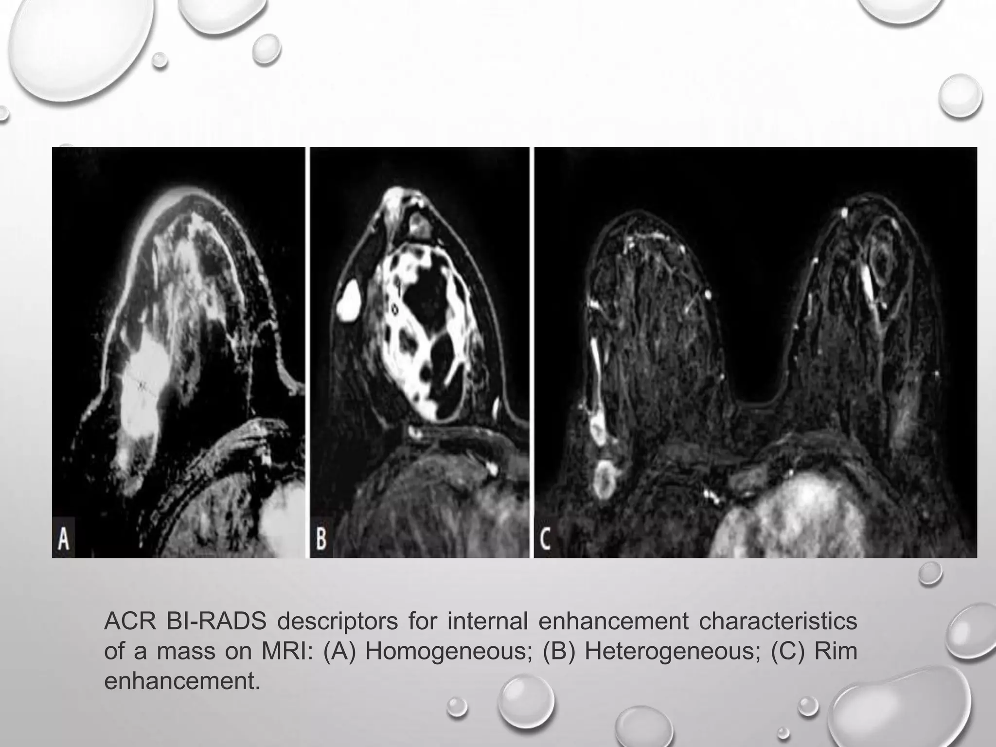 MRI BREAST PPT | PPTX