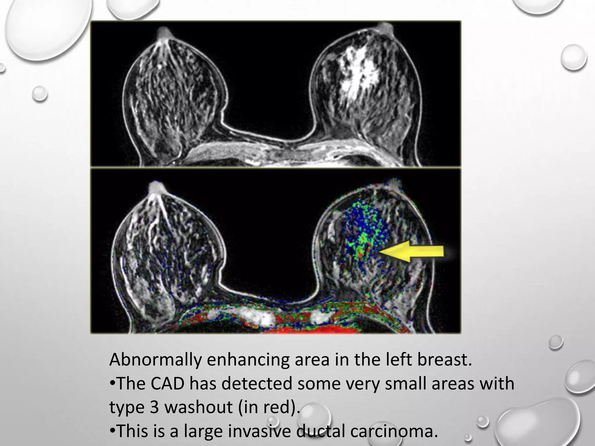MRI BREAST PPT | PPTX