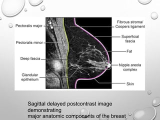 Sagittal delayed postcontrast image
demonstrating
major anatomic components of the breast
 