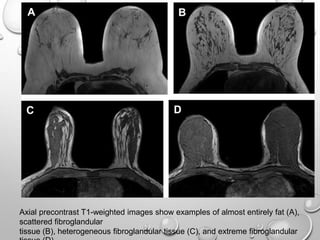 Axial precontrast T1-weighted images show examples of almost entirely fat (A),
scattered fibroglandular
tissue (B), heterogeneous fibroglandular tissue (C), and extreme fibroglandular
 