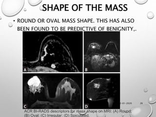 12-01-2020 26
SHAPE OF THE MASS
• ROUND OR OVAL MASS SHAPE. THIS HAS ALSO
BEEN FOUND TO BE PREDICTIVE OF BENIGNITY,.
ACR BI-RADS descriptors for mass shape on MRI: (A) Round;
(B) Oval; (C) Irregular; (D) Spiculated.
 