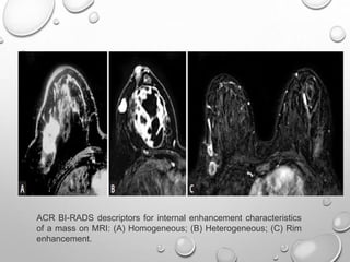 ACR BI-RADS descriptors for internal enhancement characteristics
of a mass on MRI: (A) Homogeneous; (B) Heterogeneous; (C) Rim
enhancement.
 