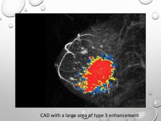 CAD with a large area of type 3 enhancement
 