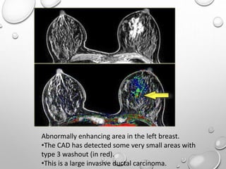 Abnormally enhancing area in the left breast.
•The CAD has detected some very small areas with
type 3 washout (in red).
•This is a large invasive ductal carcinoma.
 