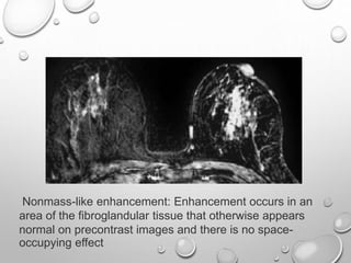 Nonmass-like enhancement: Enhancement occurs in an
area of the fibroglandular tissue that otherwise appears
normal on precontrast images and there is no space-
occupying effect
 