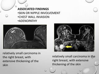 ASSOCIATED FINDINGS
•SKIN OR NIPPLE INVOLVEMENT
•CHEST WALL INVASION
•ADENOPATHY
relatively small carcinoma in
the right breast, with
extensive thickening of the
skin
relatively small carcinoma in the
right breast, with extensive
thickening of the skin
 