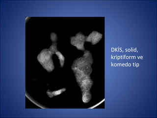 DKİS, solid,
kriptiform ve
komedo tip
 