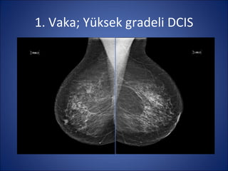 1. Vaka; Yüksek gradeli DCIS
 