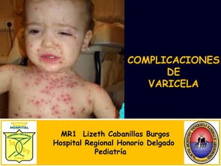 MR1 Lizeth Cabanillas Burgos
Hospital Regional Honorio Delgado
Pediatría
COMPLICACIONES
DE
VARICELA
 