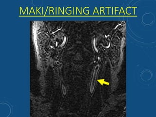 MAKI/RINGING ARTIFACT
 