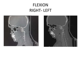 FLEXION
RIGHT- LEFT
 