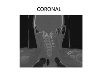 CORONAL
 