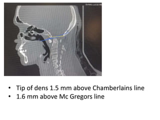 • Tip of dens 1.5 mm above Chamberlains line
• 1.6 mm above Mc Gregors line
 