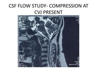 CSF FLOW STUDY- COMPRESSION AT
CVJ PRESENT
 