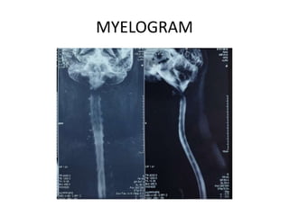MYELOGRAM
 