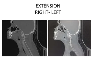 EXTENSION
RIGHT- LEFT
 