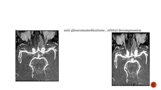  anti glaucomamedications , orbital decompression
 