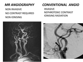 MR ANGIOGRAPHY
NON INVASIVE
NO CONTRAST REQUIRED
NON IONISING
INVASIVE
NEPHROTOXIC CONTRAST
IONISING RADIATION
CONVENTIONAL ANGIO
 