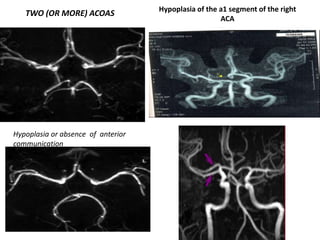 TWO (OR MORE) ACOAS
Hypoplasia or absence of anterior
communication
Hypoplasia of the a1 segment of the right
ACA
 