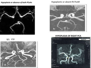 Hypoplasia or absence of both PCoAs
HYPOPLASIA OF RIGHT PCA
B/L FTP
Hypoplastic or absent Rt PcoM
 