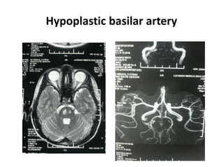 Hypoplastic basilar artery
 