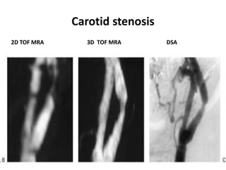 Carotid stenosis
2D TOF MRA 3D TOF MRA DSA
 