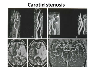 Carotid stenosis
 