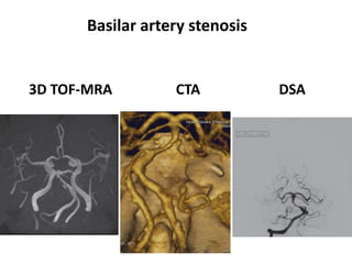 Basilar artery stenosis
3D TOF-MRA CTA DSA
 