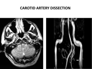 CAROTID ARTERY DISSECTION
 