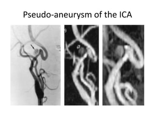 Pseudo-aneurysm of the ICA
 